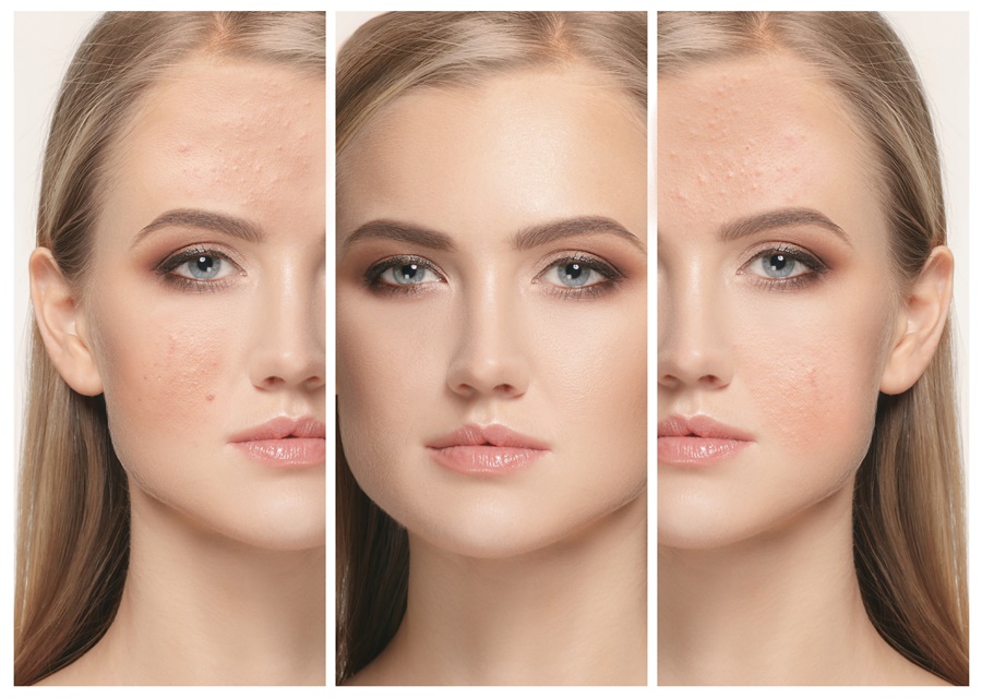 Rezultate tratament Nonacne